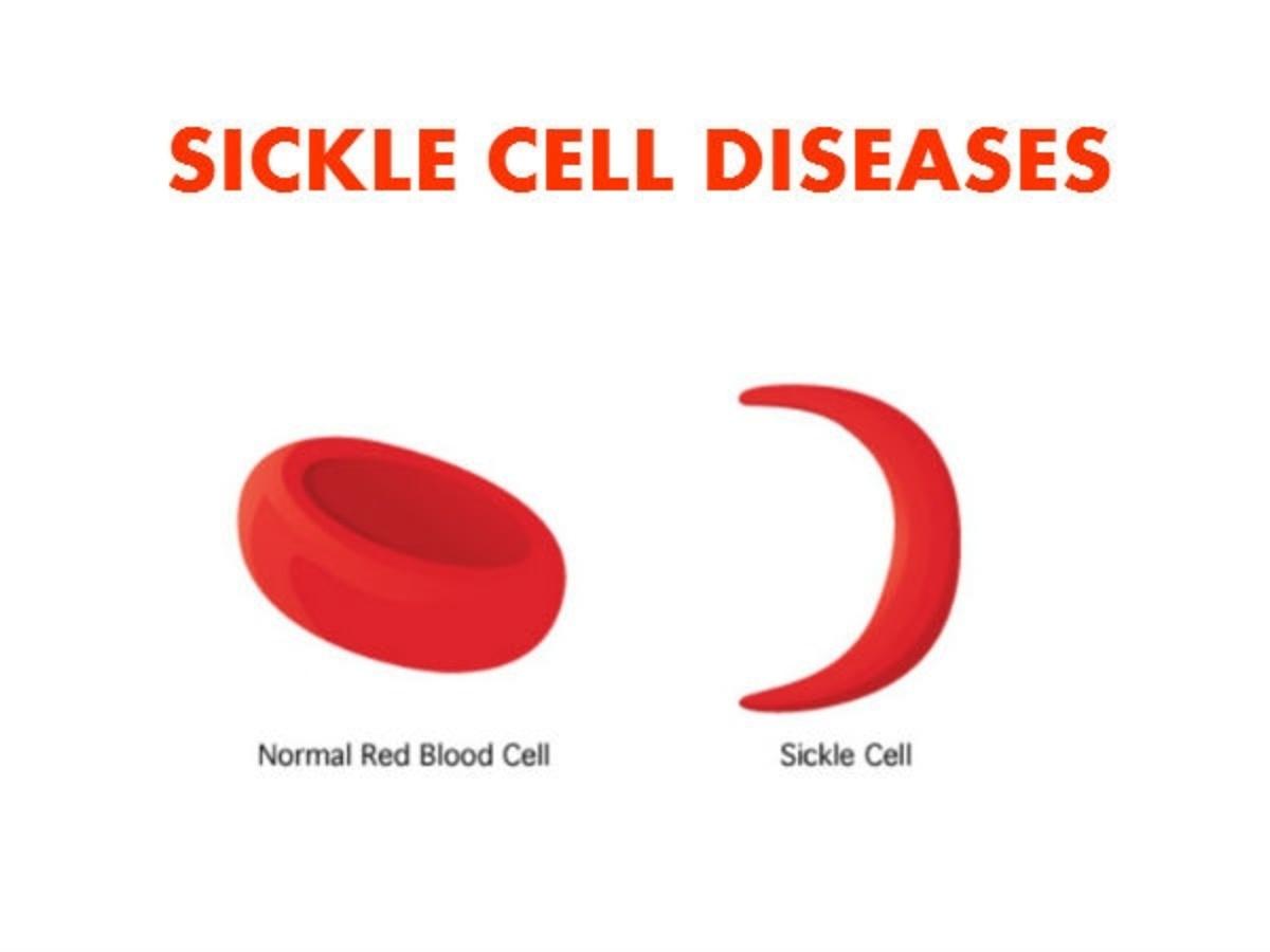 All You Need To Know About Sickle Cell Disorder - The Mail News